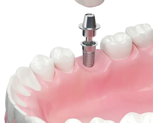 ایمپلنت دندان در مرکز ایمپلنت آرامش