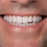 شرایط ایمپلنت دندان جلو