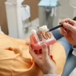 تصویر ایمپلنت دندان چقدر ماندگاری دارد