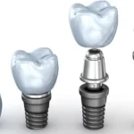 بررسی فرق هیلینگ و اباتمنت