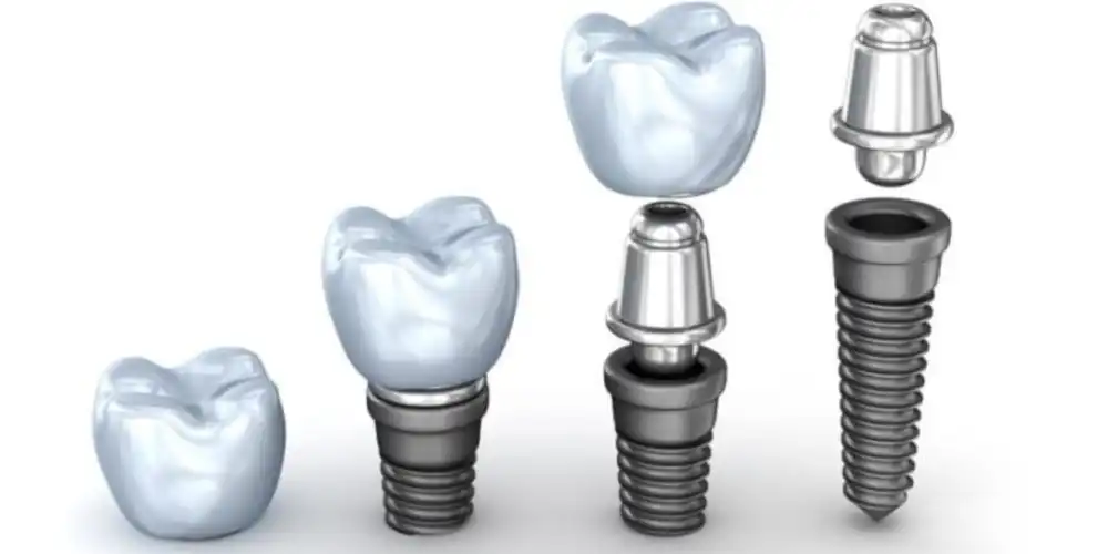 بررسی فرق هیلینگ و اباتمنت